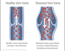 healthy veins vs diseased veins