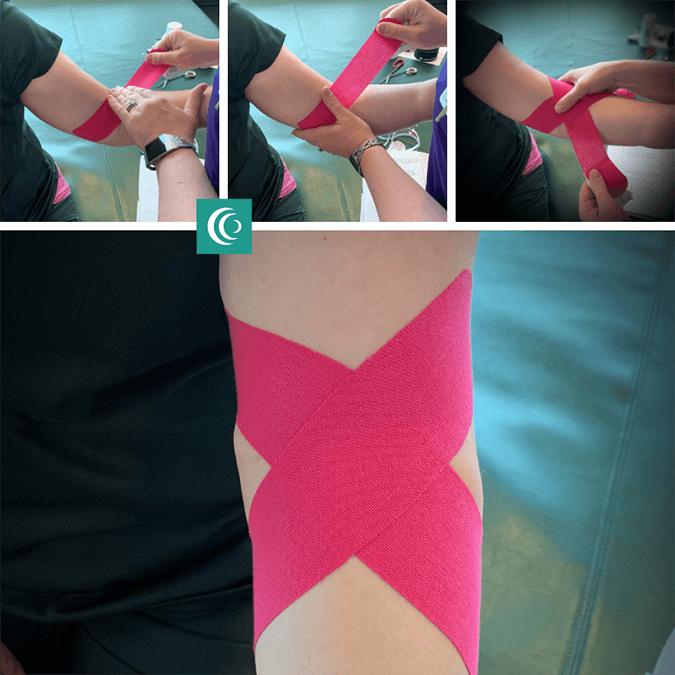 X shape: to inhibit full extension, give support and alleviate pain KT Tape CCH Rehabilitation