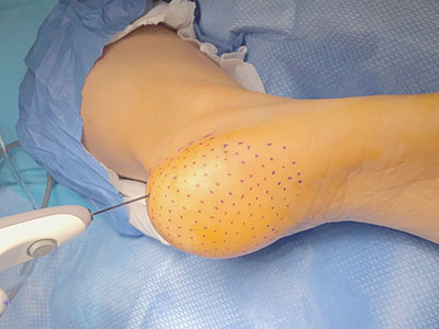 partial plantar fasciotomy with Topaz micro-tenotomy offered at PROS in Gillette, Wyoming