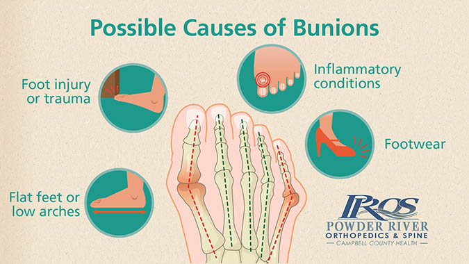 Possible causes of bunions graphic
